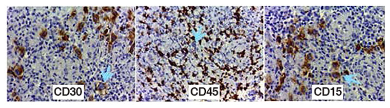 HodgkinsLymphoma-rs-cells-positive-to-CD30…-03