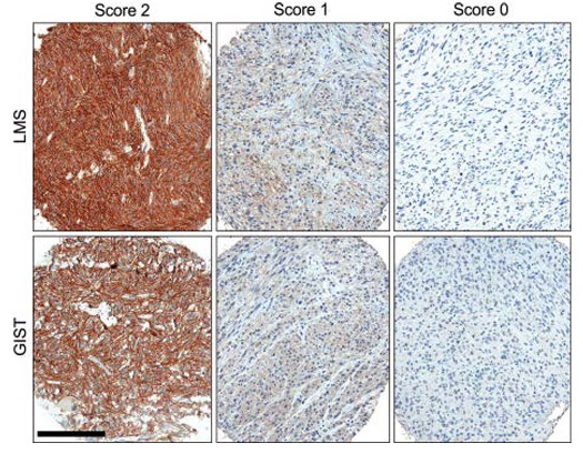 Immunohistochemistry: use at 1-10ug/ml on paraformaldehyde-fixed, paraffin-embedded sections following antigen retrieval (microwave 12 min in citrate buffer, pH 6.0). Detection of ROR2 in LMS and GIST. Samples were scored 2 (strong staining), 1 (weak staining), or 0 (absence of staining). See reference Edris B. et al.