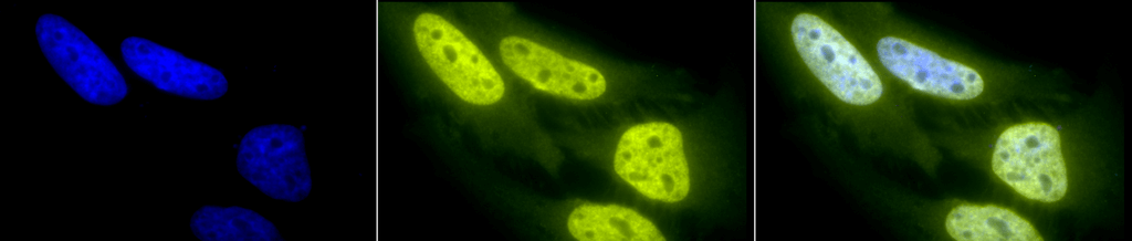 Immunocytochemistry/Immunofluorescence analysis using Rabbit Anti-Acetylated Lysine Polyclonal Antibody (56498). Tissue: Heat Shocked Cervical cancer cell line (HeLa). Species: Human. Fixation: 2% Formaldehyde for 20 min at RT. Primary Antibody: Rabbit Anti-Acetylated Lysine Polyclonal Antibody (56498) at 1:100 for 12 hours at 4°C. Secondary Antibody: FITC Goat Anti-Rabbit (green) at 1:200 for 2 hours at RT. Counterstain: DAPI (blue) nuclear stain at 1:40000 for 2 hours at RT. Localization: Nucleus. Cytoplasm. Magnification: 20x. (A) DAPI (blue) nuclear stain. (B) Anti-Acetylated Lysine Antibody. (C) Composite. Heat Shocked at 42°C for 1h.
