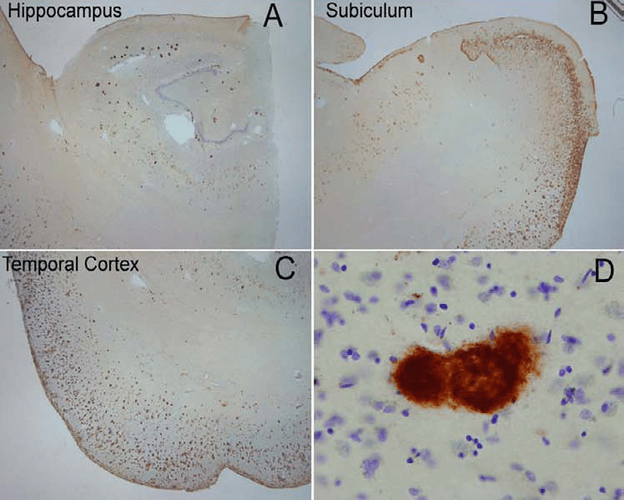 Immunohistochemistry analysis using Rabbit Anti-Amyloid Fibrils (OC) Polyclonal Antibody (57005). Tissue: Alzheimer