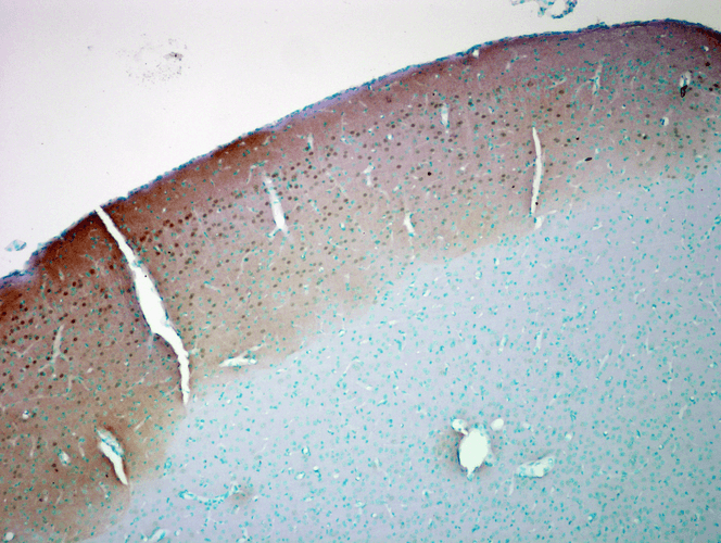 Immunohistochemistry analysis using Mouse Anti-CaMKII Monoclonal Antibody, Clone 6G9 (56453). Tissue: colon carcinoma. Species: Human. Fixation: Formalin. Primary Antibody: Mouse Anti-CaMKII Monoclonal Antibody (56453) at 1:10000 for 12 hours at 4°C. Secondary Antibody: Biotin Goat Anti-Mouse at 1:2000 for 1 hour at RT. Counterstain: Mayer Hematoxylin (purple/blue) nuclear stain at 200 µl for 2 minutes at RT. Magnification: 40x.
