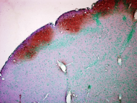 Immunohistochemistry analysis using Mouse Anti-CaMKII Monoclonal Antibody, Clone 22B1 (56454). Tissue: colon carcinoma. Species: Human. Fixation: Formalin. Primary Antibody: Mouse Anti-CaMKII Monoclonal Antibody (56454) at 1:5000 for 12 hours at 4°C. Secondary Antibody: Biotin Goat Anti-Mouse at 1:2000 for 1 hour at RT. Counterstain: Mayer Hematoxylin (purple/blue) nuclear stain at 200 µl for 2 minutes at RT. Magnification: 40x.