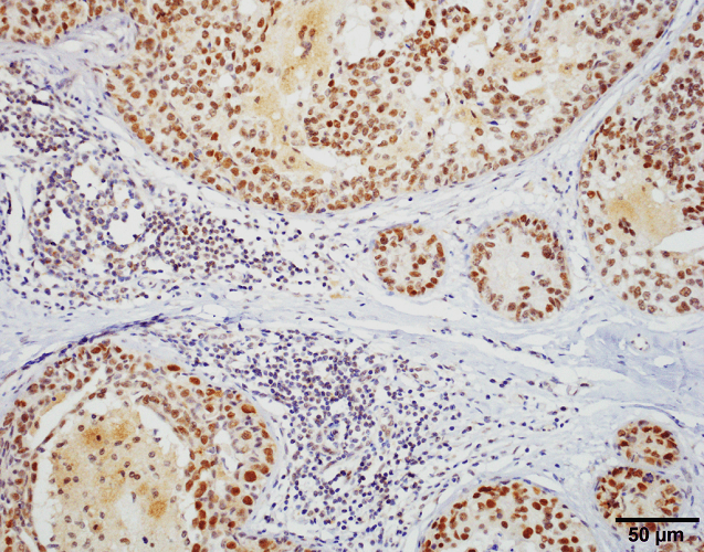 Immunohistochemistry analysis using Rat Anti-HSF1 Monoclonal Antibody, Clone 10H8 (12518). Tissue: Breast carcinoma. Species: Human. Fixation: 10% Formalin Solution for 20 hours at RT. Primary Antibody: Rat Anti-HSF1 Monoclonal Antibody (12518) at 1:1000 for 40 min. Secondary Antibody: Dako labeled Polymer HRP Anti-rat IgG, DAB Chromogen (brown) (Dako Envision+ System) for 30 min at RT. Counterstain: Mayer