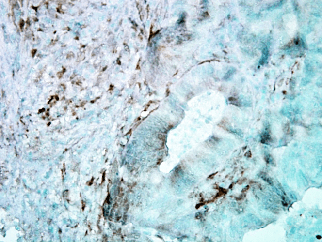 Immunohistochemistry analysis using Mouse Anti-Hsp27 Monoclonal Antibody, Clone 8A7 (11110). Tissue: colon carcinoma. Species: Human. Fixation: Formalin. Primary Antibody: Mouse Anti-Hsp27 Monoclonal Antibody (11110) at 1:5000 for 12 hours at 4°C. Secondary Antibody: Biotin Goat Anti-Mouse at 1:2000 for 1 hour at RT. Counterstain: Mayer Hematoxylin (purple/blue) nuclear stain at 200 µl for 2 minutes at RT. Localization: Inflammatory cells. Magnification: 40x.