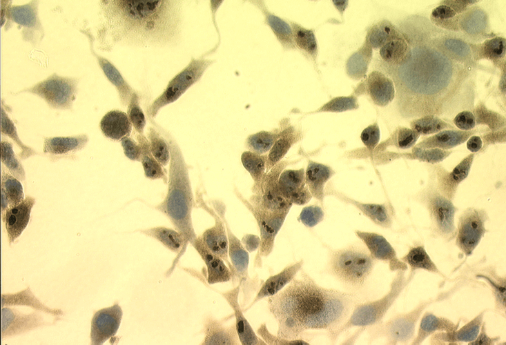 Immunocytochemistry/Immunofluorescence analysis using Mouse Anti-Hsp70 Monoclonal Antibody, Clone C92F3A-5 (11096). Tissue: Heat Shocked Melanoma cells. Species: Mouse. Fixation: Formalin. Primary Antibody: Mouse Anti-Hsp70 Monoclonal Antibody (11096) at 1:1000 for 16 hours at RT. Secondary Antibody: Biotin Goat Anti-Mouse. Courtesy of: Dr. Ewa Malusecka, Maria Sklodowska-Curie Memorial Cancer Centre and Inst. Of Oncology, Poland.