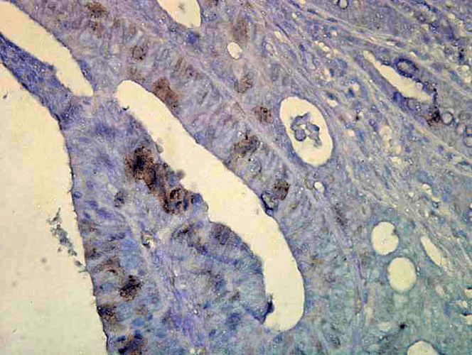 Immunohistochemistry analysis using Mouse Anti-Hsp70 Monoclonal Antibody, Clone C92F3A-5 (11096). Tissue: colon carcinoma. Species: Human. Fixation: Formalin. Primary Antibody: Mouse Anti-Hsp70 Monoclonal Antibody (11096) at 1:10000 for 12 hours at 4°C. Secondary Antibody: Biotin Goat Anti-Mouse at 1:2000 for 1 hour at RT. Counterstain: Mayer Hematoxylin (purple/blue) nuclear stain at 200 µl for 2 minutes at RT. Localization: Inflammatory cells. Magnification: 40x. This image was produced using an amplifying IHC wash buffer. The antibody has therefore been diluted more than is recommended for other applications.