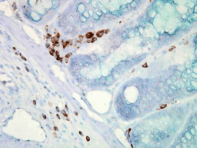 Immunohistochemistry analysis using Mouse Anti-Hsp70 Monoclonal Antibody, Clone C92F3A-5 (11096). Tissue: colon carcinoma. Species: Mouse. Fixation: Formalin. Primary Antibody: Mouse Anti-Hsp70 Monoclonal Antibody (11096) at 1:10000 for 12 hours at 4°C. Secondary Antibody: Biotin Goat Anti-Mouse at 1:2000 for 1 hour at RT. Counterstain: Mayer Hematoxylin (purple/blue) nuclear stain at 200 µl for 2 minutes at RT. Localization: Inflammatory cells. Magnification: 40x. This image was produced using an amplifying IHC wash buffer. The antibody has therefore been diluted more than is recommended for other applications.