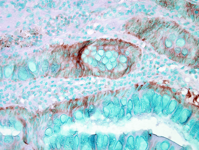 Immunohistochemistry analysis using Rabbit Anti-HSP70 Polyclonal Antibody (11108). Tissue: colon carcinoma. Species: Human. Fixation: Formalin. Primary Antibody: Rabbit Anti-HSP70 Polyclonal Antibody (11108) at 1:50000 for 12 hours at 4°C. Secondary Antibody: Biotin Goat Anti-Rabbit at 1:2000 for 1 hour at RT. Counterstain: Methyl Green at 200uL for 2 min at RT.