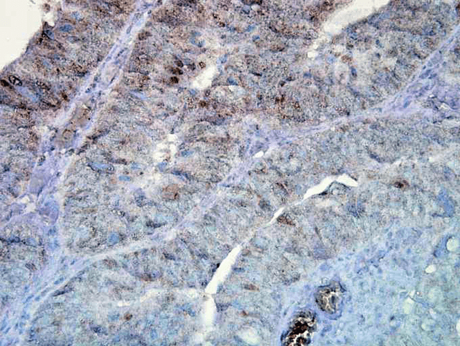 Immunohistochemistry analysis using Mouse Anti-Hsp90 Monoclonal Antibody, Clone D7alpha (11102). Tissue: colon carcinoma. Species: Human. Fixation: Formalin. Primary Antibody: Mouse Anti-Hsp90 Monoclonal Antibody (11102) at 1:100000 for 12 hours at 4°C. Secondary Antibody: Biotin Goat Anti-Mouse at 1:2000 for 1 hour at RT. Counterstain: Mayer Hematoxylin (purple/blue) nuclear stain at 200 µl for 2 minutes at RT. Magnification: 40x. This image was produced using an amplifying IHC wash buffer. The antibody has therefore been diluted more than is recommended for other applications.