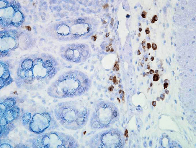 Immunohistochemistry analysis using Mouse Anti-Hsp90 Monoclonal Antibody, Clone D7alpha (11102). Tissue: inflamed colon. Species: Mouse. Fixation: Formalin. Primary Antibody: Mouse Anti-Hsp90 Monoclonal Antibody (11102) at 1:100000 for 12 hours at 4°C. Secondary Antibody: Biotin Goat Anti-Mouse at 1:2000 for 1 hour at RT. Counterstain: Mayer Hematoxylin (purple/blue) nuclear stain at 200 µl for 2 minutes at RT. Localization: Inflammatory cells. Magnification: 40x. Inflammatory cells. This image was produced using an amplifying IHC wash buffer. The antibody has therefore been diluted more than is recommended for other applications.