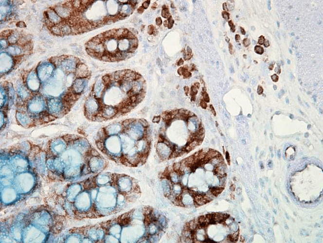 Immunohistochemistry analysis using Mouse Anti-Hsp90 Monoclonal Antibody, Clone H9010 (11098). Tissue: colon carcinoma. Species: Human. Fixation: Formalin. Primary Antibody: Mouse Anti-Hsp90 Monoclonal Antibody (11098) at 1:10000 for 12 hours at 4°C. Secondary Antibody: Biotin Goat Anti-Mouse at 1:2000 for 1 hour at RT. Counterstain: Mayer Hematoxylin (purple/blue) nuclear stain at 200 µl for 2 minutes at RT. Localization: Inflammatory cells. Magnification: 40x. This image was produced using an amplifying IHC wash buffer. The antibody has therefore been diluted more than is recommended for other applications.