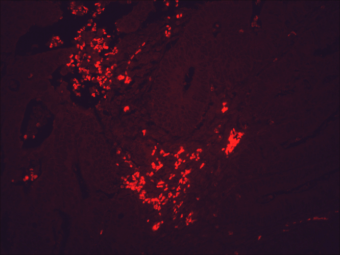 Immunohistochemistry analysis using Mouse Anti-Hsp90 Monoclonal Antibody, Clone H9010 (11098). Tissue: colon carcinoma. Species: Human. Fixation: Formalin. Primary Antibody: Mouse Anti-Hsp90 Monoclonal Antibody (11098) at 1:10000 for 12 hours at 4°C. Secondary Antibody: Alexa Fluor 555 Goat Anti-Mouse (red) at 1:5000 for 1 hour at RT. Magnification: 40x. This image was produced using an amplifying IHC wash buffer. The antibody has therefore been diluted more than is recommended for other applications.