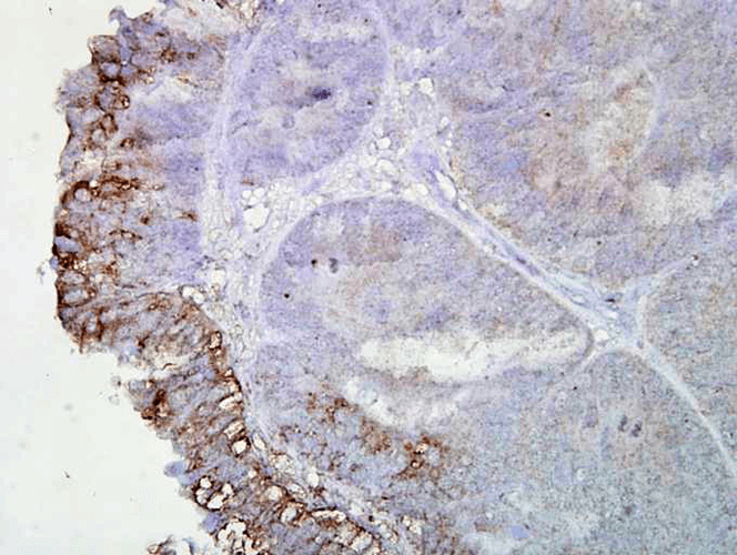 Immunohistochemistry analysis using Mouse Anti-Hsp90 Monoclonal Antibody, Clone AC-16 (11104). Tissue: colon carcinoma. Species: Human. Fixation: Formalin. Primary Antibody: Mouse Anti-Hsp90 Monoclonal Antibody (11104) at 1:2000 for 12 hours at 4°C. Secondary Antibody: Biotin Goat Anti-Mouse at 1:2000 for 1 hour at RT. Counterstain: Mayer Hematoxylin (purple/blue) nuclear stain at 200 µl for 2 minutes at RT. Localization: Inflammatory cells. Magnification: 40x. Inflammatory cells. This image was produced using an amplifying IHC wash buffer. The antibody has therefore been diluted more than is recommended for other applications.
