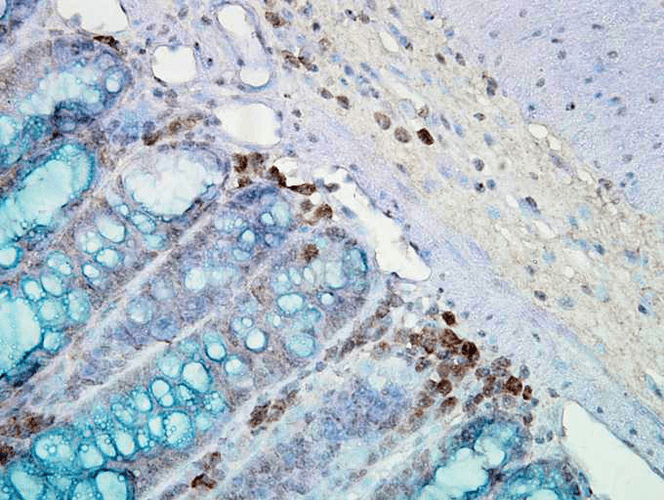 Immunohistochemistry analysis using Mouse Anti-Hsp90 Monoclonal Antibody, Clone AC-16 (11104). Tissue: inflamed colon. Species: Mouse. Fixation: Formalin. Primary Antibody: Mouse Anti-Hsp90 Monoclonal Antibody (11104) at 1:2000 for 12 hours at 4°C. Secondary Antibody: Biotin Goat Anti-Mouse at 1:2000 for 1 hour at RT. Counterstain: Mayer Hematoxylin (purple/blue) nuclear stain at 200 µl for 2 minutes at RT. Localization: Inflammatory cells. Magnification: 40x. Mostly inflammatory cells, some mucosa. This image was produced using an amplifying IHC wash buffer. The antibody has therefore been diluted more than is recommended for other applications.