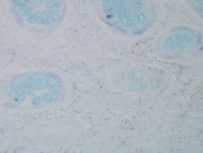 Immunohistochemistry analysis using Mouse Anti-Nitrotyrosine Monoclonal Antibody, Clone 39B6 (56456). Tissue: colon carcinoma. Species: Human. Fixation: Formalin. Primary Antibody: Mouse Anti-Nitrotyrosine Monoclonal Antibody (56456) at 1:25000 for 12 hours at 4°C. Secondary Antibody: Biotin Goat Anti-Mouse at 1:2000 for 1 hour at RT. Counterstain: Mayer Hematoxylin (purple/blue) nuclear stain at 200 µl for 2 minutes at RT. Magnification: 40x.