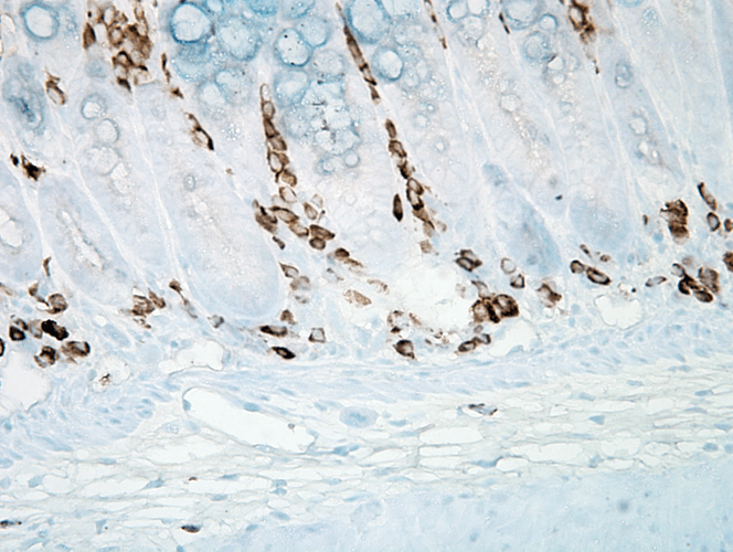 Immunohistochemistry analysis using Mouse Anti-Nitrotyrosine Monoclonal Antibody, Clone 39B6 (56456). Tissue: inflamed colon. Species: Mouse. Fixation: Formalin. Primary Antibody: Mouse Anti-Nitrotyrosine Monoclonal Antibody (56456) at 1:1000000 for 12 hours at 4°C. Secondary Antibody: Biotin Goat Anti-Mouse at 1:2000 for 1 hour at RT. Counterstain: Mayer Hematoxylin (purple/blue) nuclear stain at 200 µl for 2 minutes at RT. Magnification: 40x. With anti-microbial.