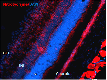 Immunohistochemistry analysis using Mouse Anti-Nitrotyrosine Monoclonal Antibody, Clone 39B6 (56456). Tissue: Retinal Injury Model. Species: Mouse. Primary Antibody: Mouse Anti-Nitrotyrosine Monoclonal Antibody (56456) at 1:1000. Secondary Antibody: Alexa Fluor 594 Goat Anti-Mouse (red). Courtesy of: Dr. Rajashekhar Gangaraju, University of Indiana, Department of Ophthalmology, Eugene and Marilyn Glick Eye Institute.