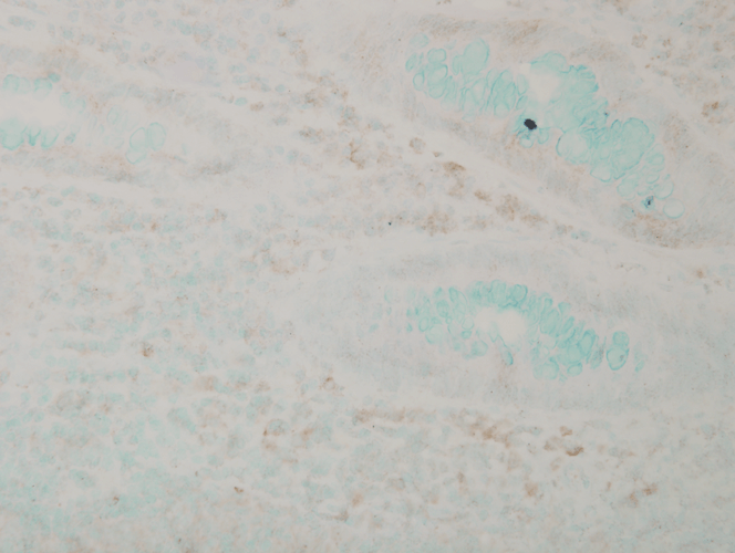 Immunohistochemistry analysis using Mouse Anti-p38 MAPK Monoclonal Antibody, Clone 9F12 (56450). Tissue: colon carcinoma. Species: Human. Fixation: Formalin. Primary Antibody: Mouse Anti-p38 MAPK Monoclonal Antibody (56450) at 1:10000 for 12 hours at 4°C. Secondary Antibody: Biotin Goat Anti-Mouse at 1:2000 for 1 hour at RT. Counterstain: Mayer Hematoxylin (purple/blue) nuclear stain at 200 µl for 2 minutes at RT. Magnification: 40x.
