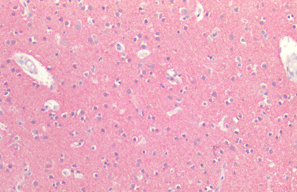 Immunohistochemistry analysis using Rabbit Anti-Tau Polyclonal Antibody (57011). Tissue: Brain Cortex. Species: Human. Fixation: Formalin fixed paraffin-embedded. Primary Antibody: Rabbit Anti-Tau Polyclonal Antibody (57011).