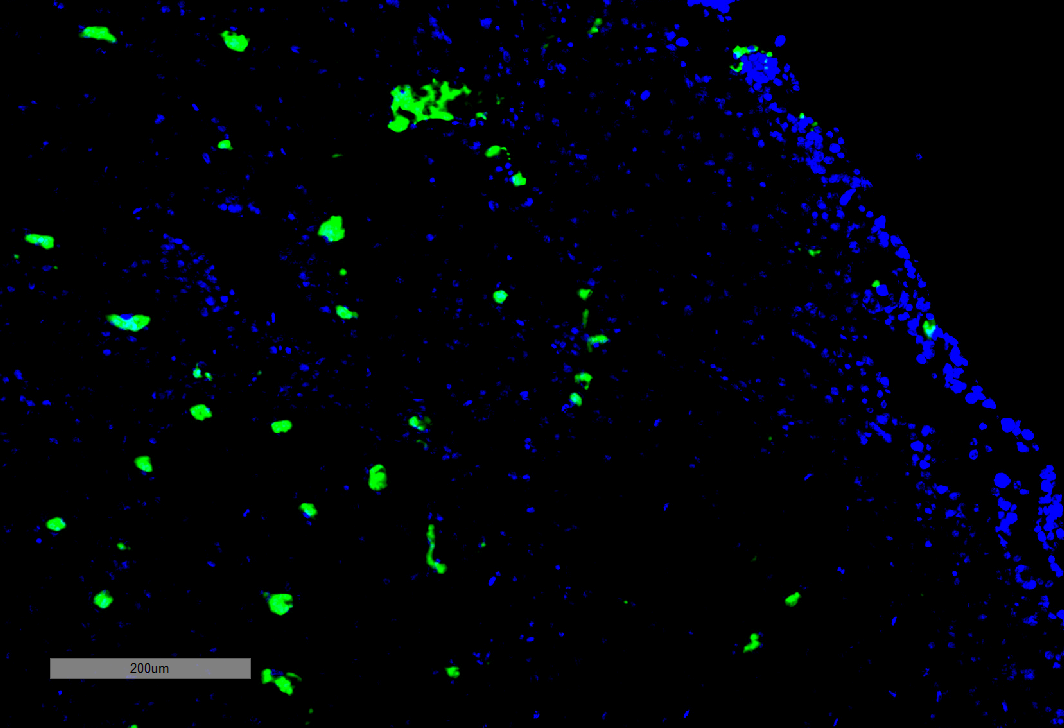 Immunohistochemistry analysis using Mouse Anti-Acrolein Monoclonal Antibody, Clone 10A10 . Tissue: Adrenal Carcinoma. Species: Human. Primary Antibody: Mouse Anti-Acrolein Monoclonal Antibody at 1:100 for Overnight at 4C, then 30 min at 37C. Secondary Antibody: Goat Anti-Mouse IgG (H+L): FITC for 45 min at 37C. Counterstain: DAPI for 3 min at RT. Magnification: 5X.